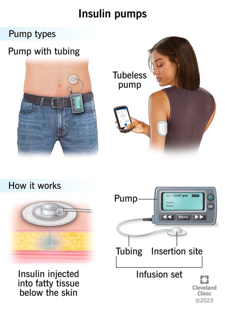 Spring-Energized Seals in Medical Devices